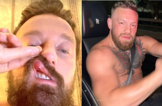 Francesco Facchinetti picchiato da Conor McGregor: “Vivo per miracolo, potevo morire”